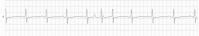 SVEB Couplets Rhythm Strip